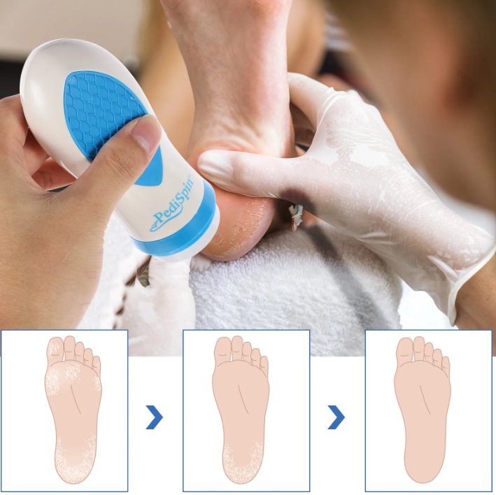 Foot Care Callus Remover for Smoothness